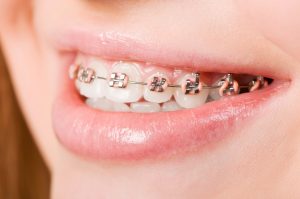 The Importance Of Dental Braces